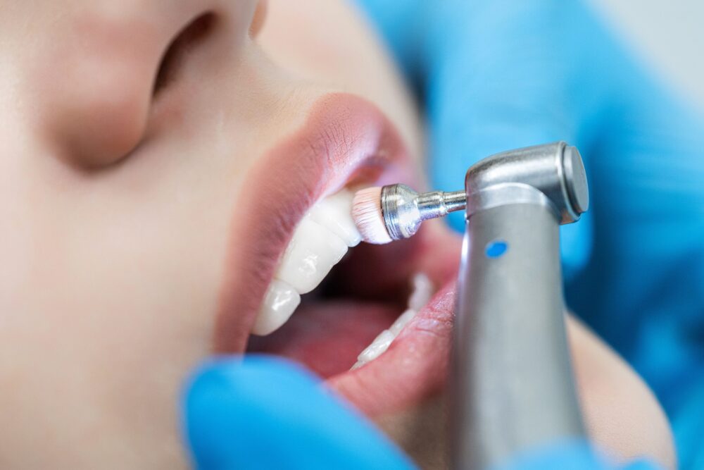 Dental Cleanings plain city